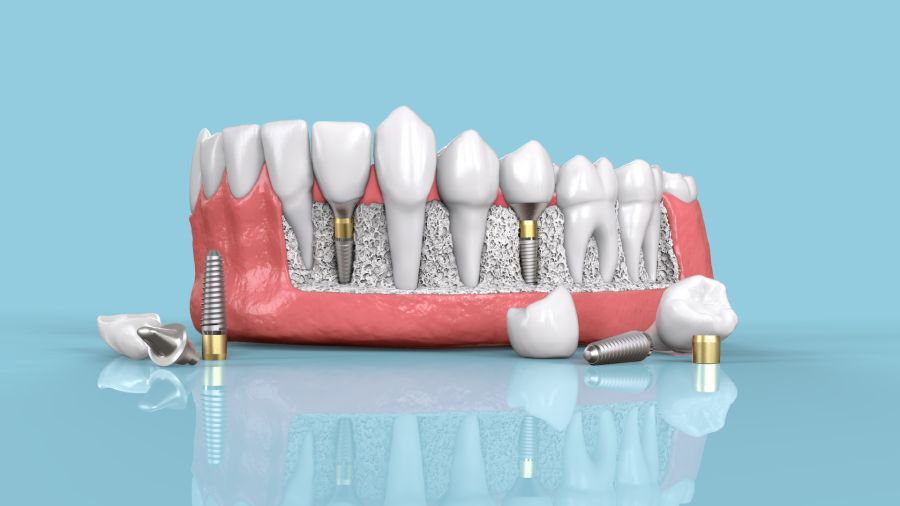 implant dentar Corbeanca implantologie
