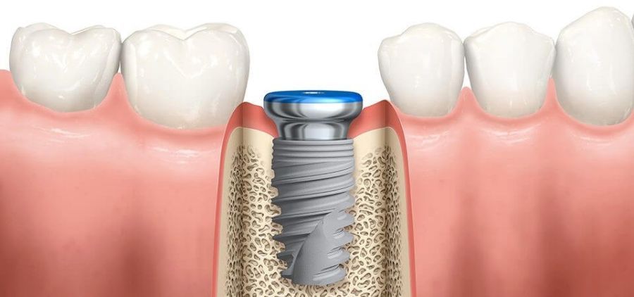 implant dentsr Corbeanca, clinica implantologie Corbeanca