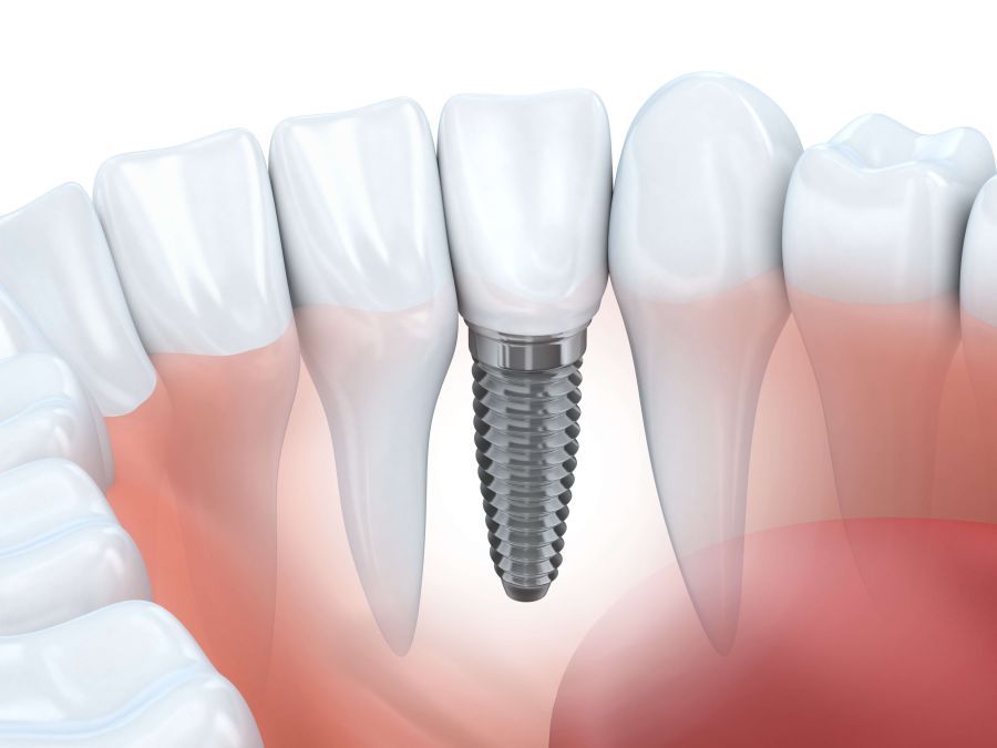 implant dentar, estetica dentara Corbeanca
