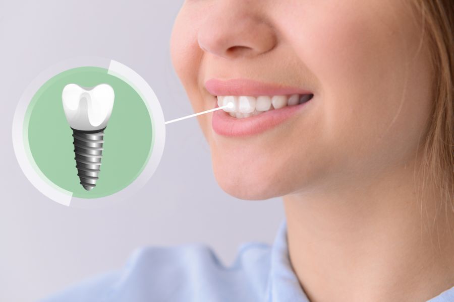 implant dentar, estetica dentara Corbeanca