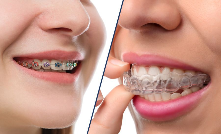 Read more about the article Cu ce este special aparatul dentar Invisalign față de aparatul dentar tradițional?