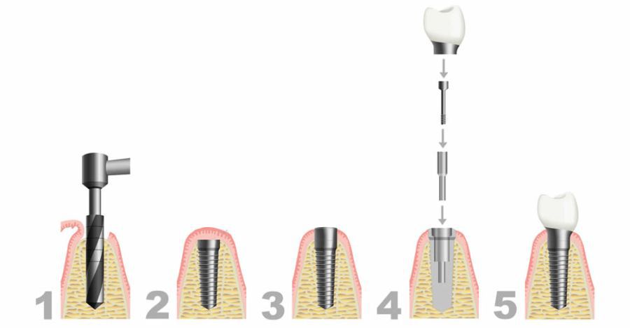 implant dentar Corbeanca Bucuresti
